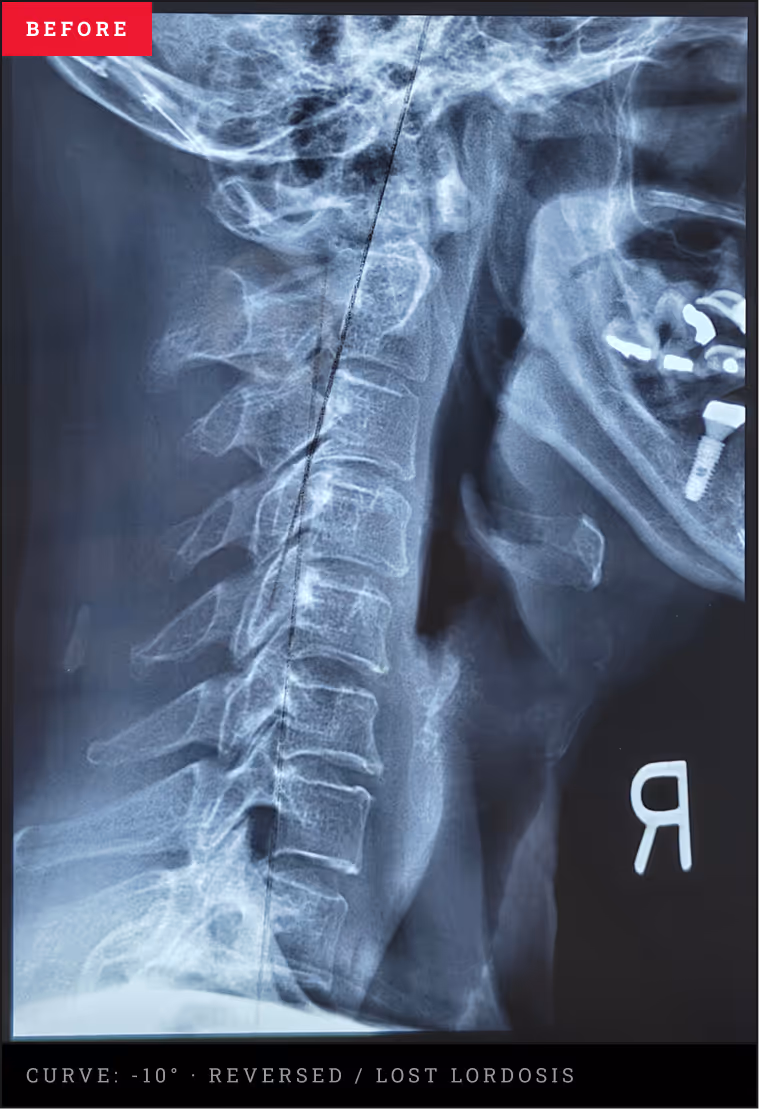 Cervical spine X-ray showing reversed curve before treatment