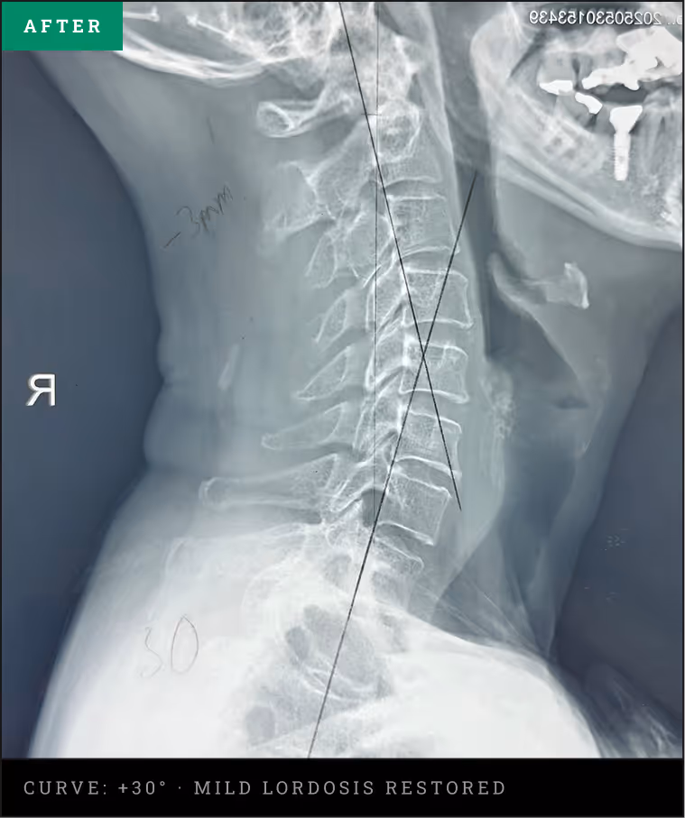 Cervical spine X-ray showing restored healthy curve after treatment